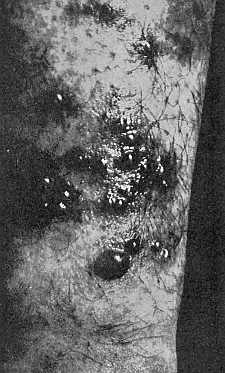 43. Effect of the harvest mites on the skin of man. Photograph by
J. C. Bradley.