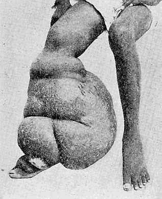 119. Elephantiasis in Man. From "New
Sydenham Society's Atlas."